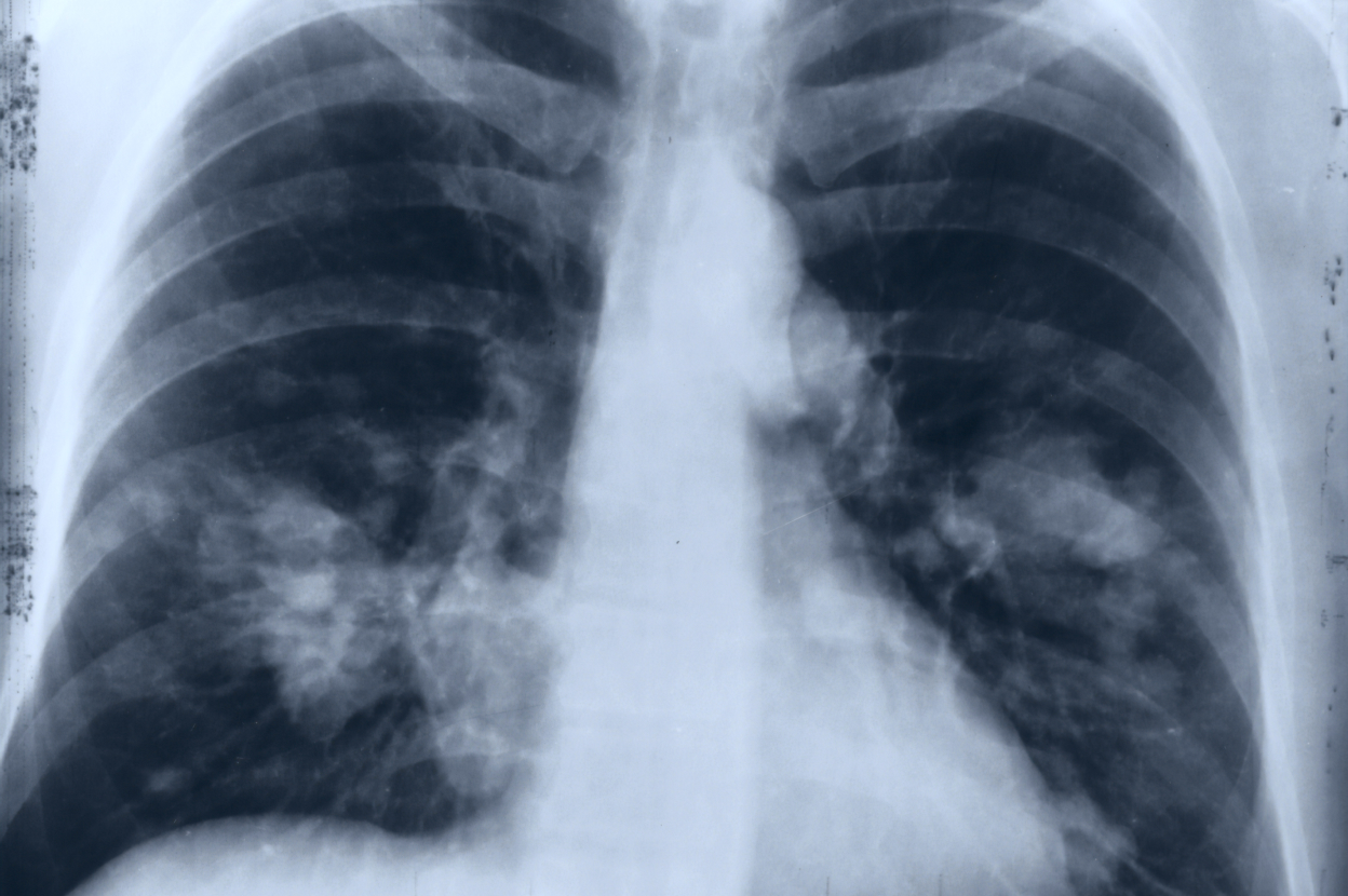 An X-ray view into the human body’s abdomen, revealing the skeleton and meant to showcase connections between cystic fibrosis and poor oral health – Viome Oral Health Intelligence Test 