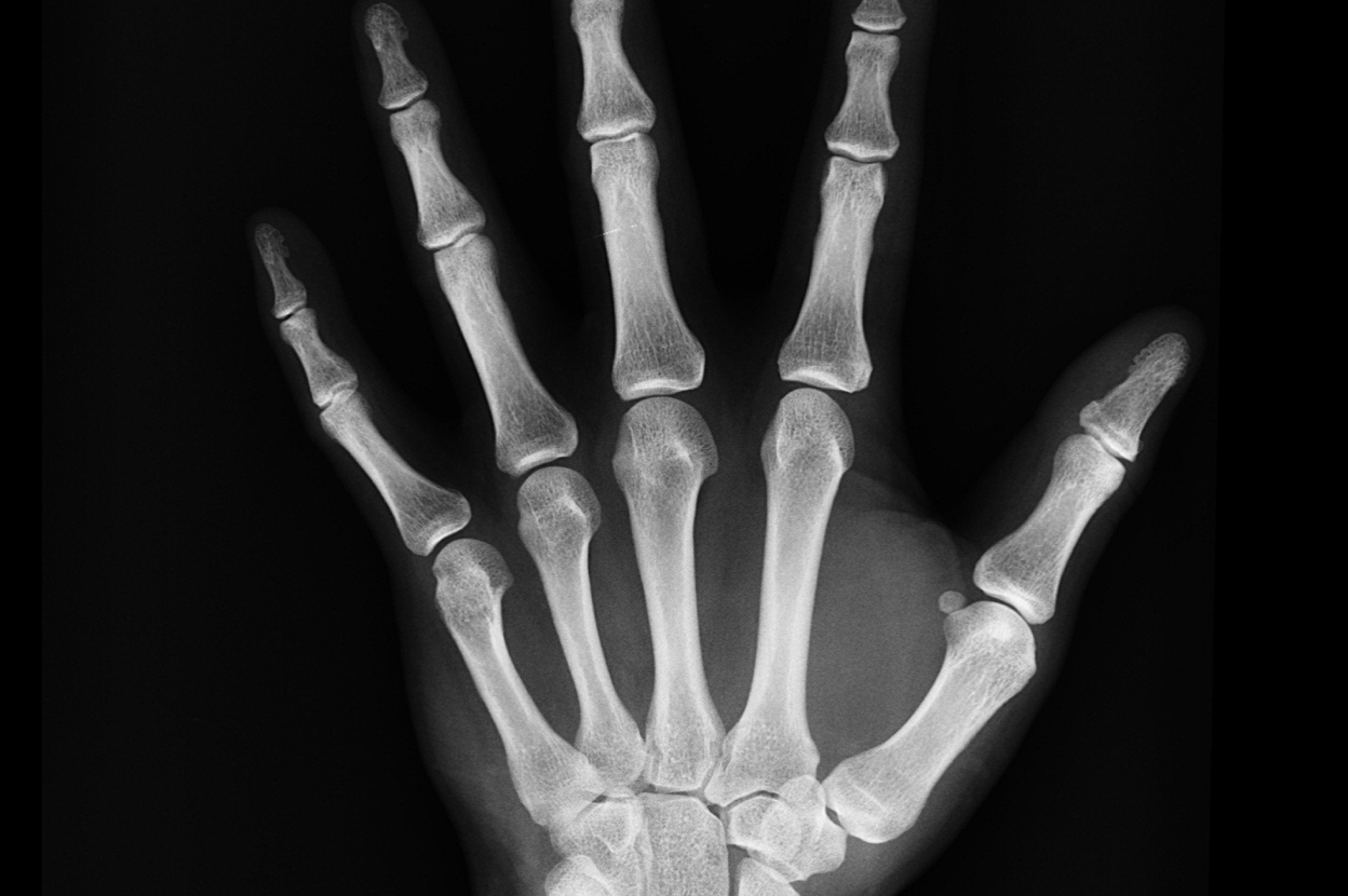 An X-ray of a human hand, meant to reveal the connection between poor oral health and rheumatoid arthritis – Viome Oral Health Intelligence Test 